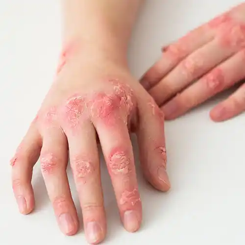 Hand-Allergy-2